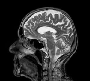 badanie głowy rezonansem magnetycznym